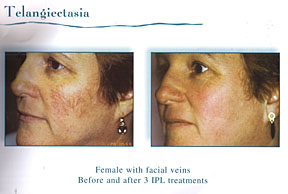 Chicago Laser Skin Rejuvenation